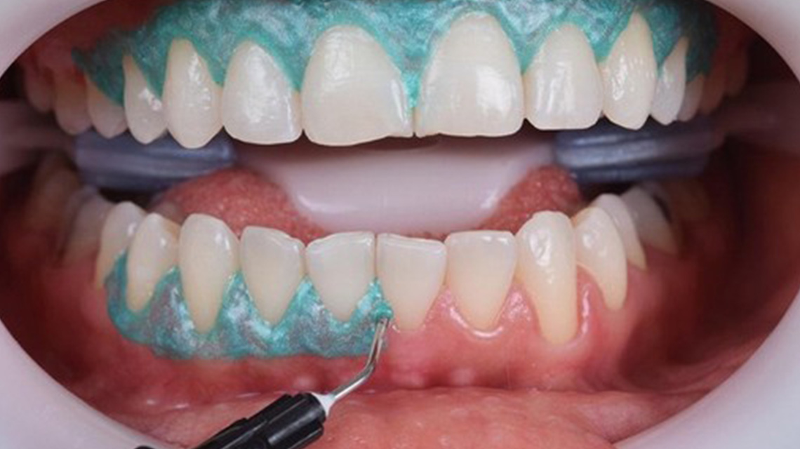 Cosmetic Dental Treatments